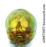 espingarda, ferimento, raio x