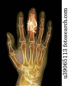 Foreign body in finger, X-ray