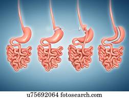 Weight loss surgery, computer illustration. From left to right are: a normal stomach, a gastric band, a gastric bypass and a sleeve gastrectomy.