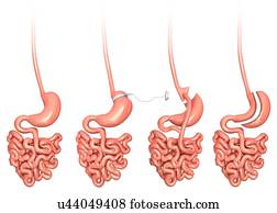 Weight loss surgery, computer illustration. From left to right are: a normal stomach, a gastric band, a gastric bypass and a sleeve gastrectomy.