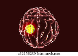 câncer cérebro, artwork