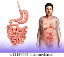 Sleeve gastrectomy, illustration