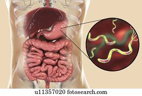 Helicobacter pylori bacteria. Computer illustration of Helicobacter pylori bacteria in a human stomach. Formerly known as Campylobacter pyloridis, these are spiral-shaped Gram-negative bacteria. The terminal flagella (hair-like structures) are used...