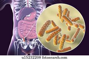 Klebsiella sintomi