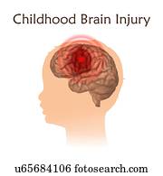 infancia, cérebro, ferimento, illustration., danificado, criança, brain.