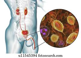 Prostatitis és trichomoniasis pmn elasztáz vizsgálat