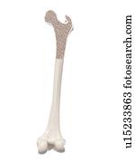 Illustration of osteoporosis.