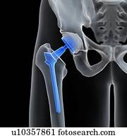 ilustração, de, um, quadril, replacement.