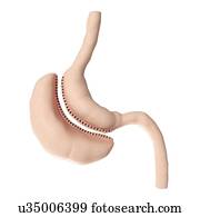 Illustration of a vertical sleeve gastrectomy