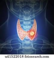 ilustração, de, tiróide, câncer