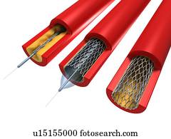 Balloon, angioplastia, artwork