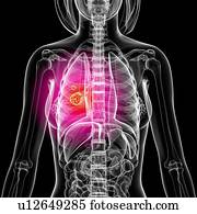 câncer pulmão, artwork