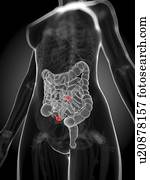 intestinal, câncer, artwork