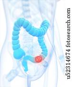 câncer cólon, artwork