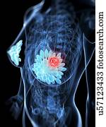 câncer peito, artwork