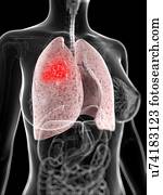 câncer pulmão, artwork