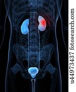 rim, câncer, artwork