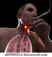 laringe, câncer, artwork