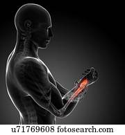 Human wrist pain, artwork